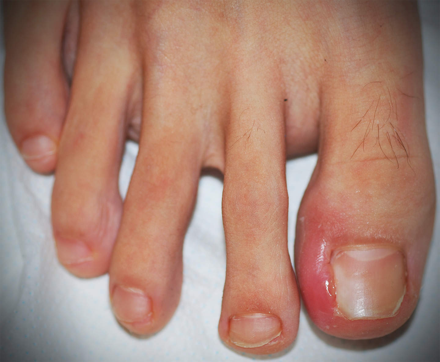 La cura dell’unghia incarnita