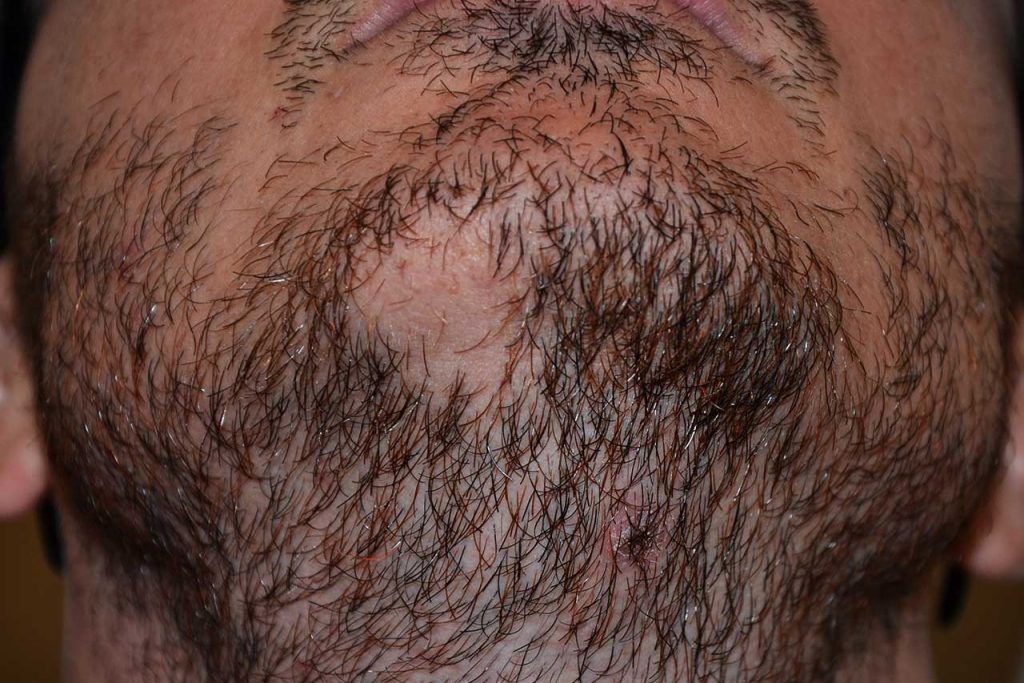 Malattie della barba: pseudofolliculiti e alopecia areata della barba