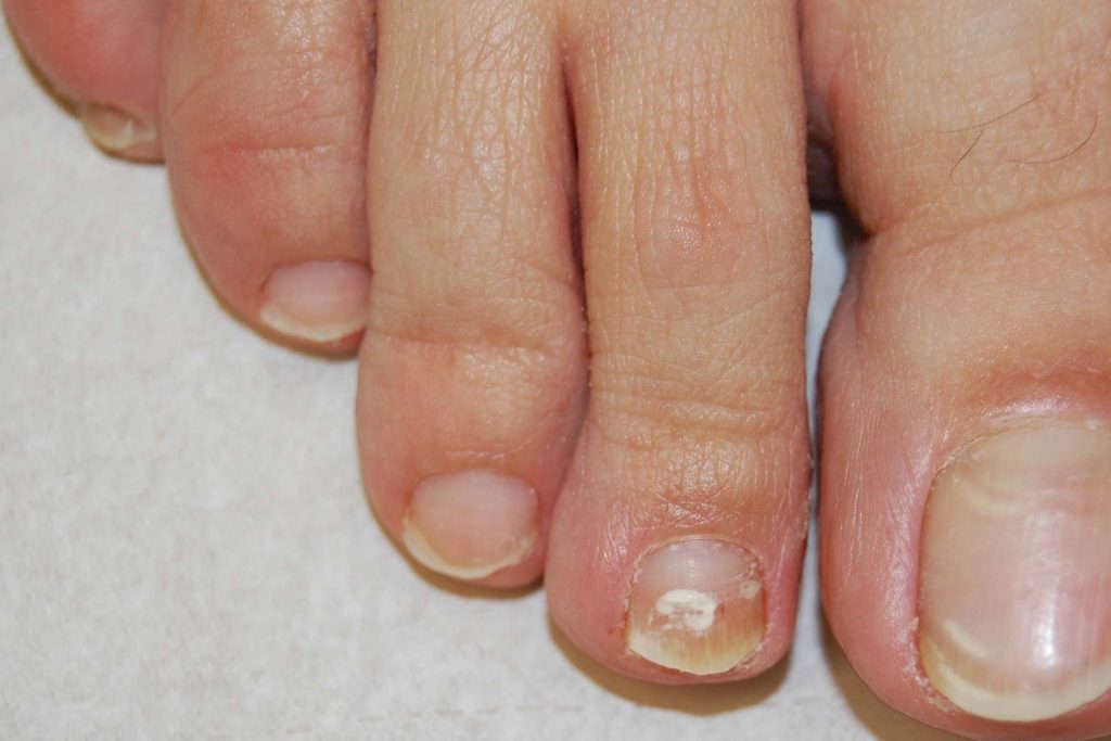 Malattie delle unghie dei piedi