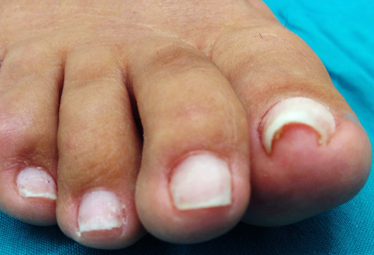 Malattie delle unghie dei piedi: come riconoscerle e trattarle