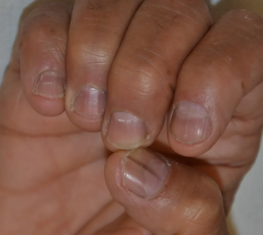 La Melanonichia Striata: quando l’unghia è nera