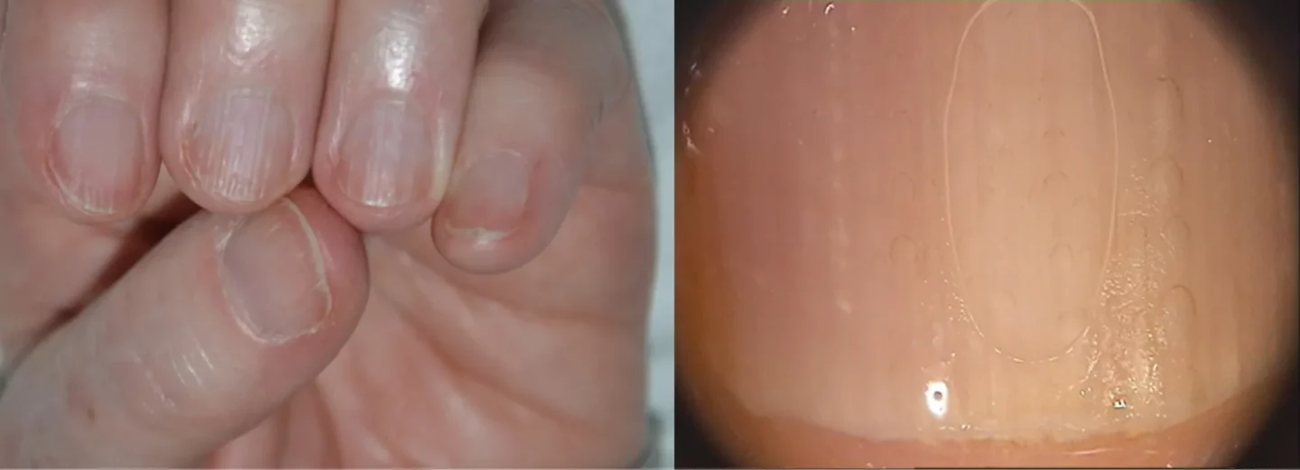 fragilità unghie anziani