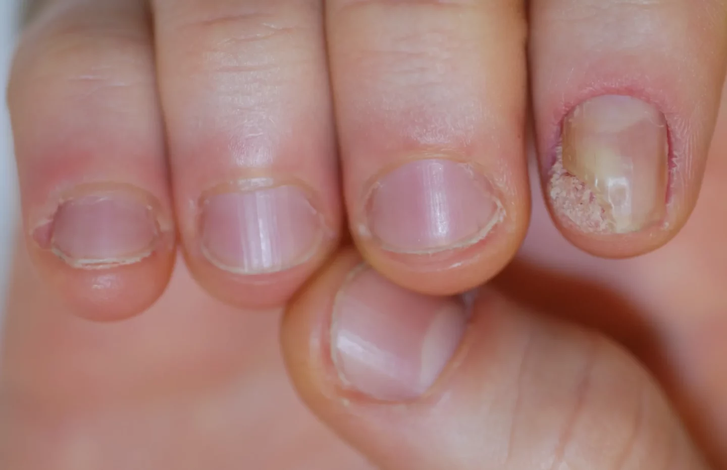 carcinoma squamocellulare dell'unghia