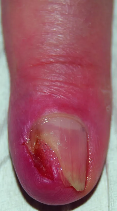 carcinoma squamocellulare dell'unghia con ulcera