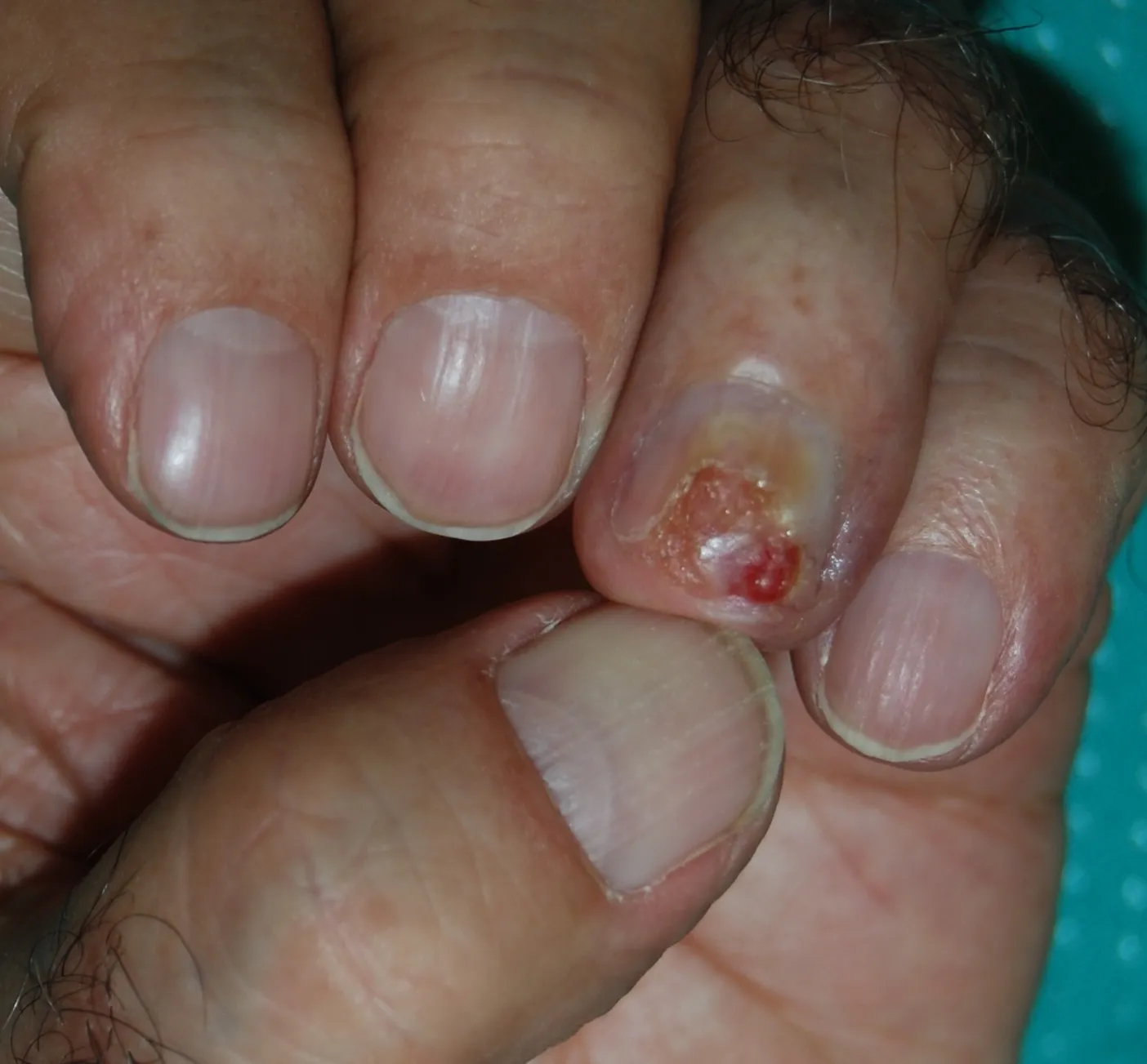 carcinoma squamocellulare dell'unghia con ulcera