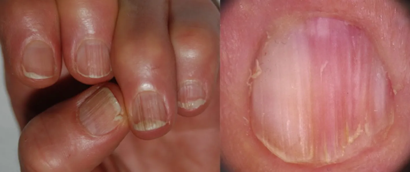 Le unghie dell’anziano