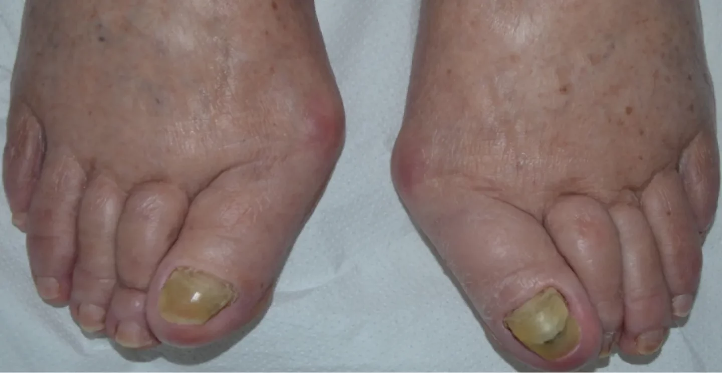 unghie gialle con alluce valgo