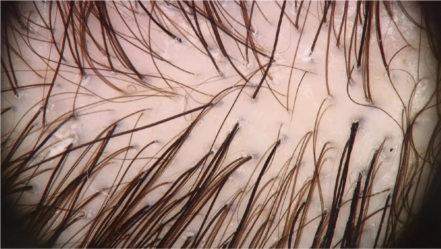 telogen effluvium in associazione all'alopecia androgenetica