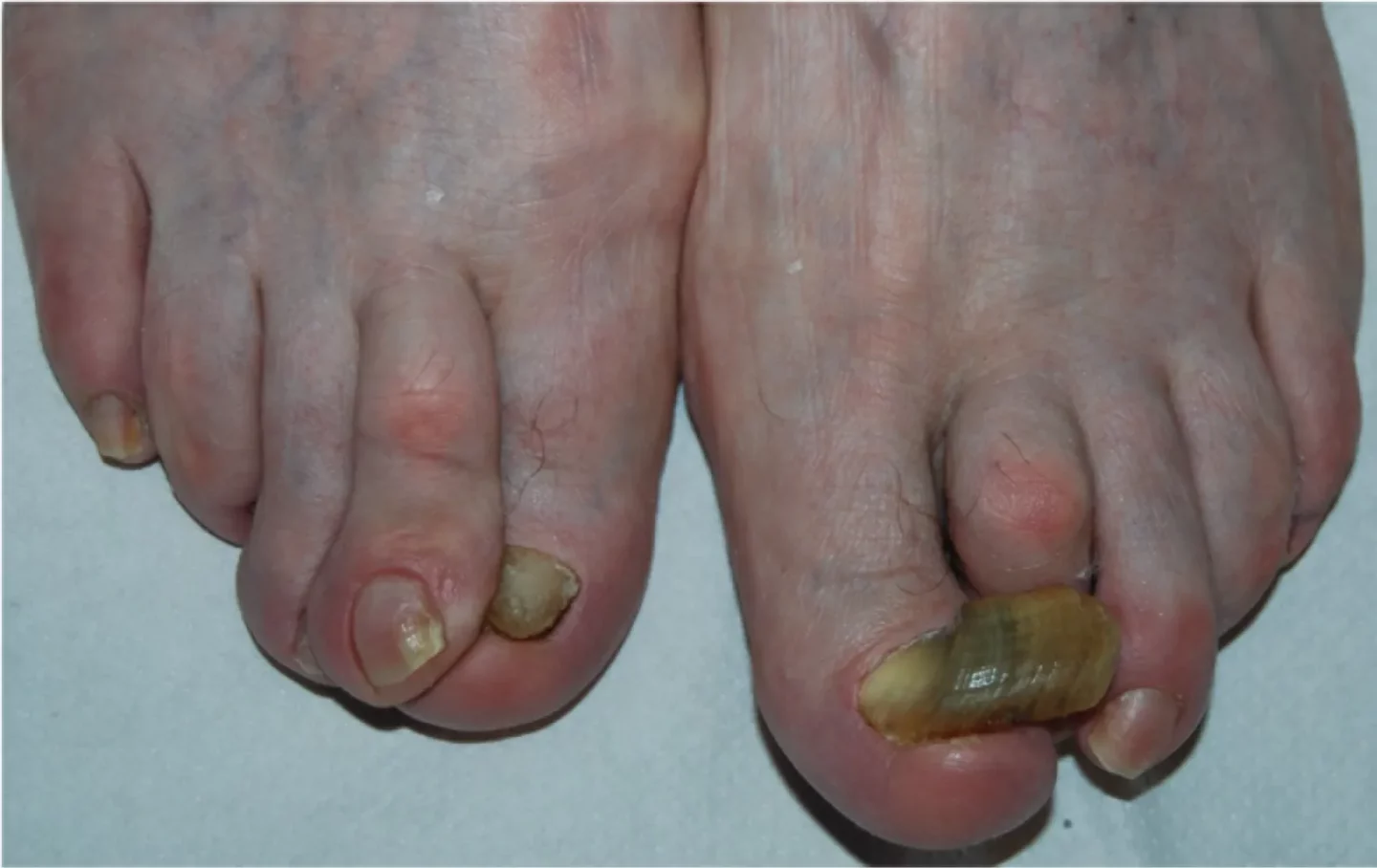 unghie con onicogrifosi