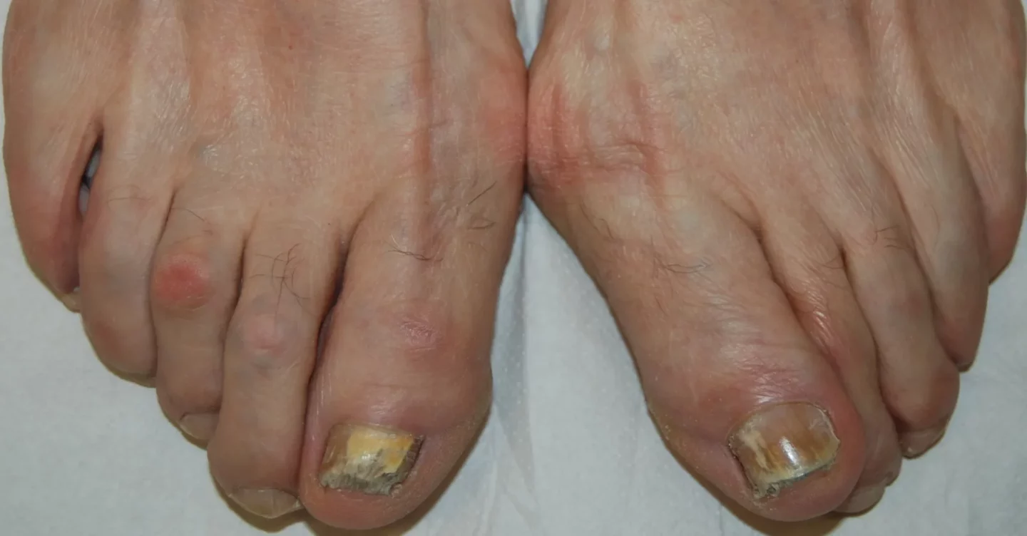 unghia con onicomicosi