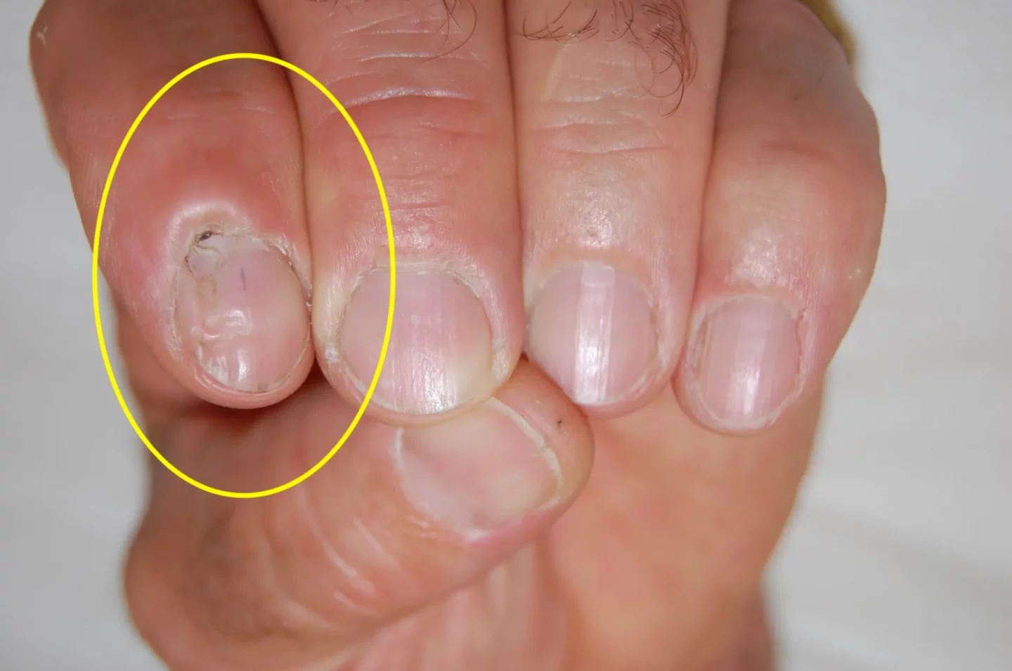 cisti mucosa digitale