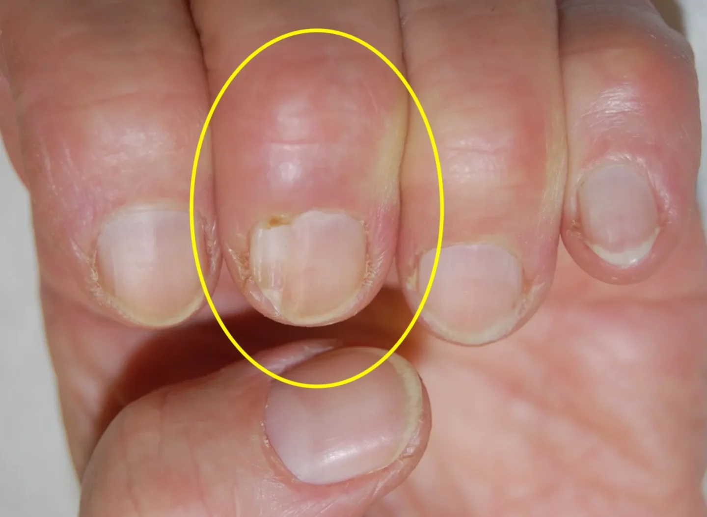 cisti mucosa digitale