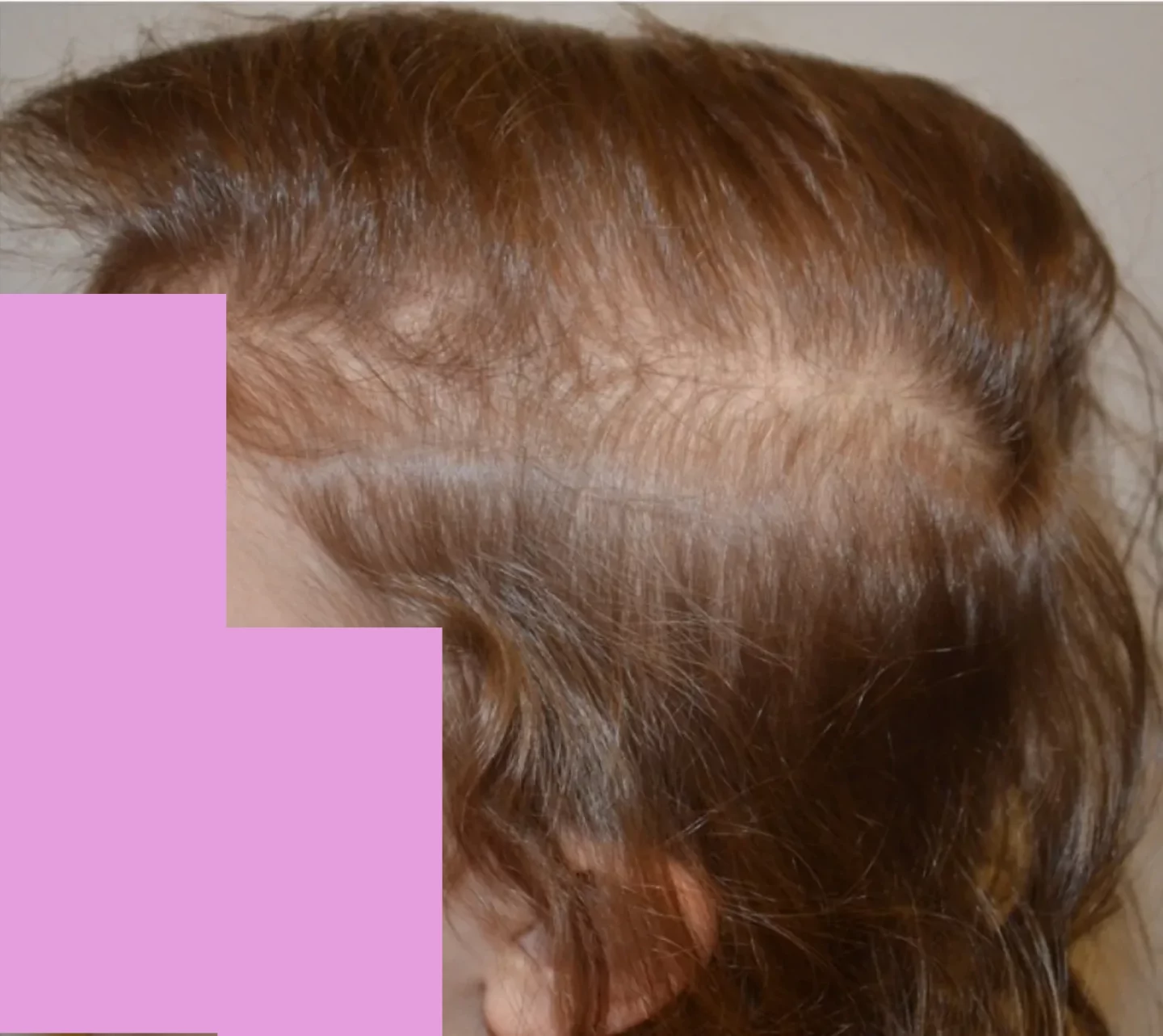 capelli assottigliati in bambino