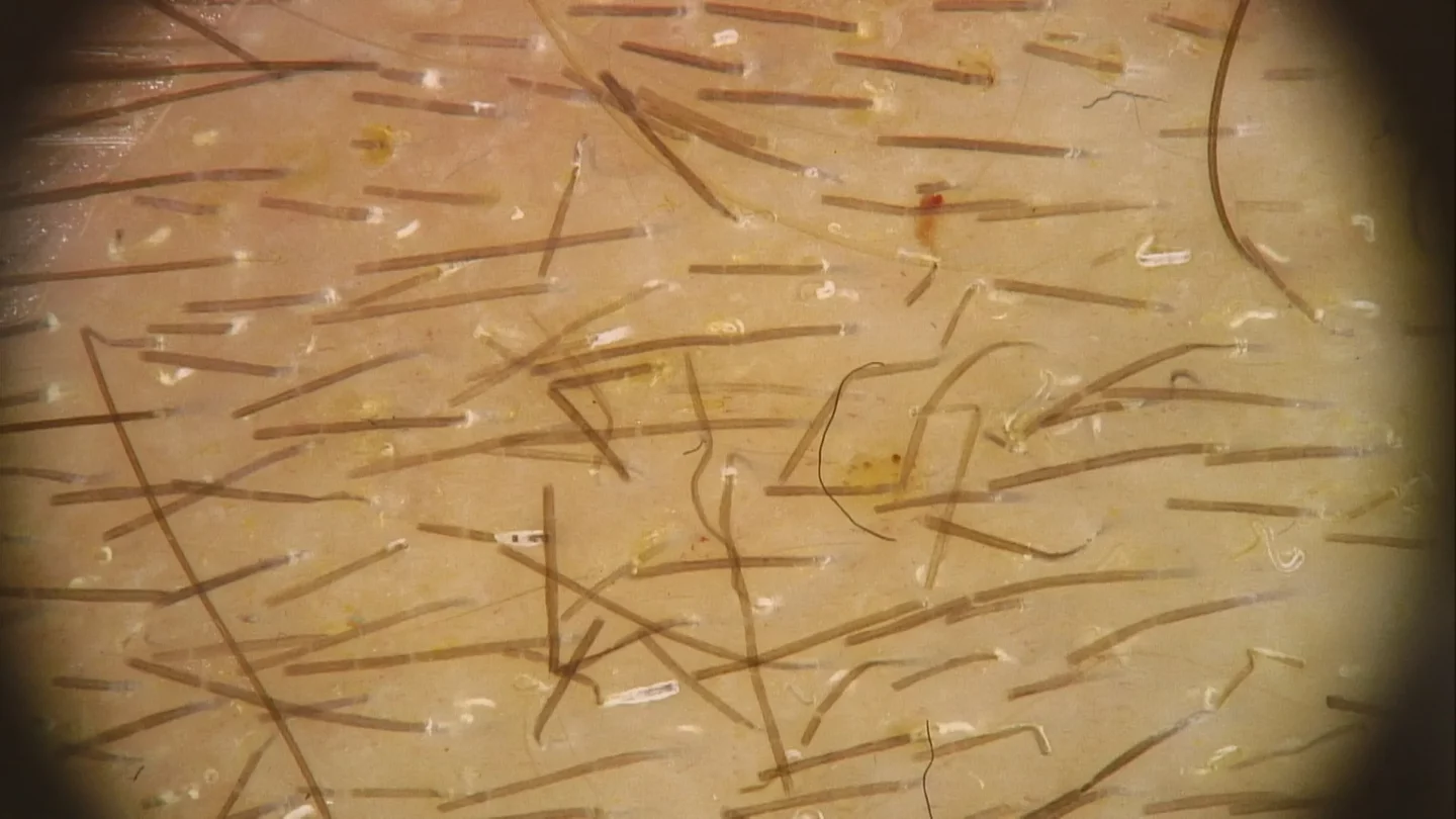 tricoscopia di paziente con tinea capitis