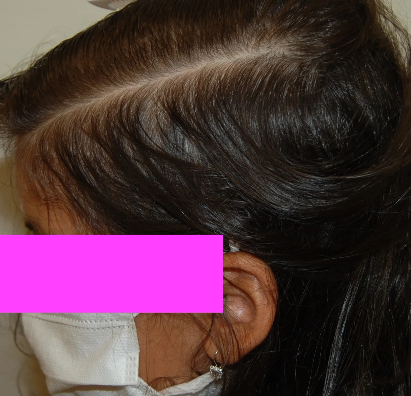 paziente con telogen effluvium