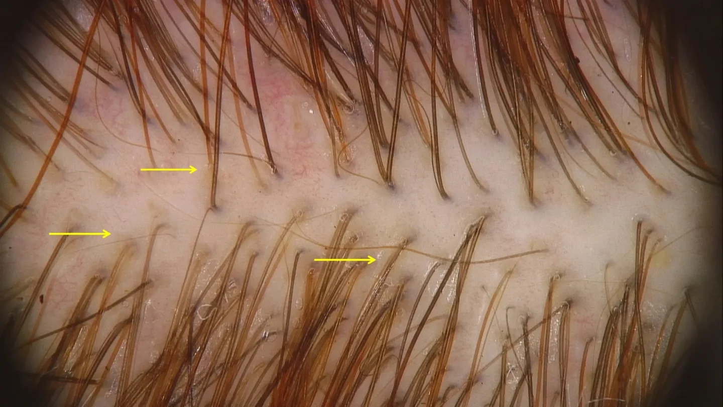 tricoscopia di paziente con telogen effluvium