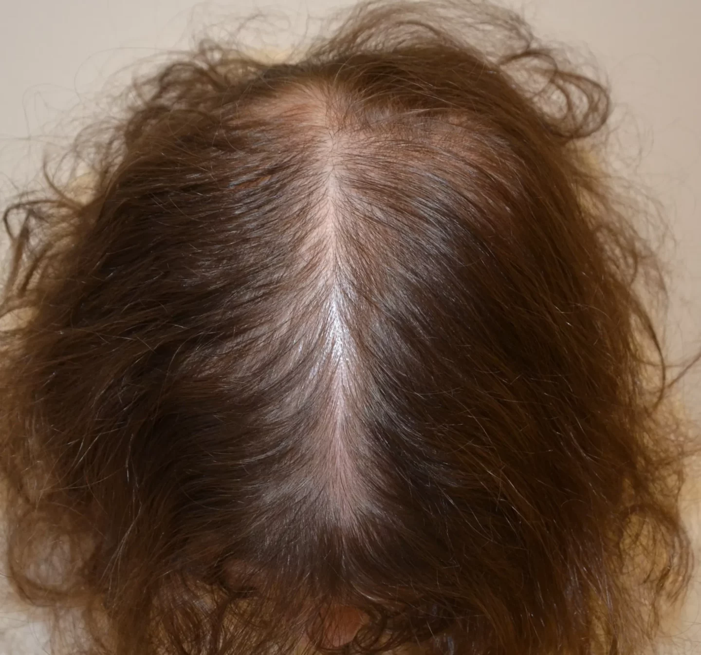 paziente con alopecia androgenetica