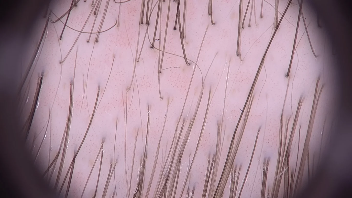 tricoscopia di paziente con alopecia androgenetica