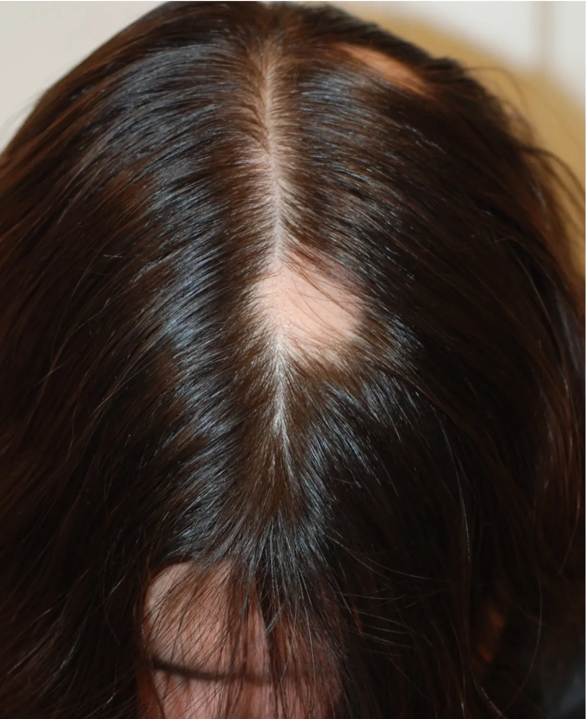chiazza rotondeggiante di alopecia areata