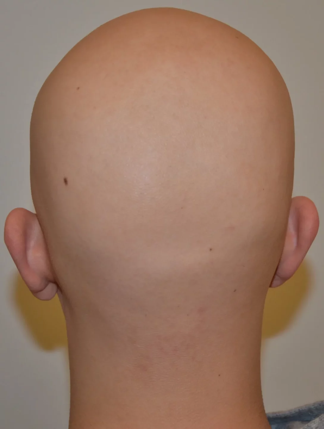 alopecia areata totale