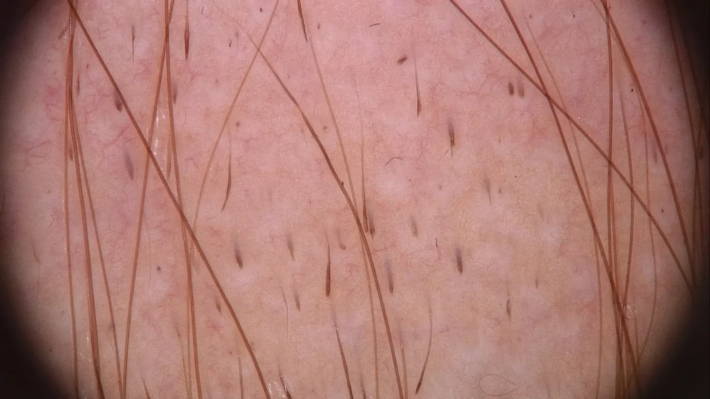 immagine tricoscopica di cute con alopecia areata acuta