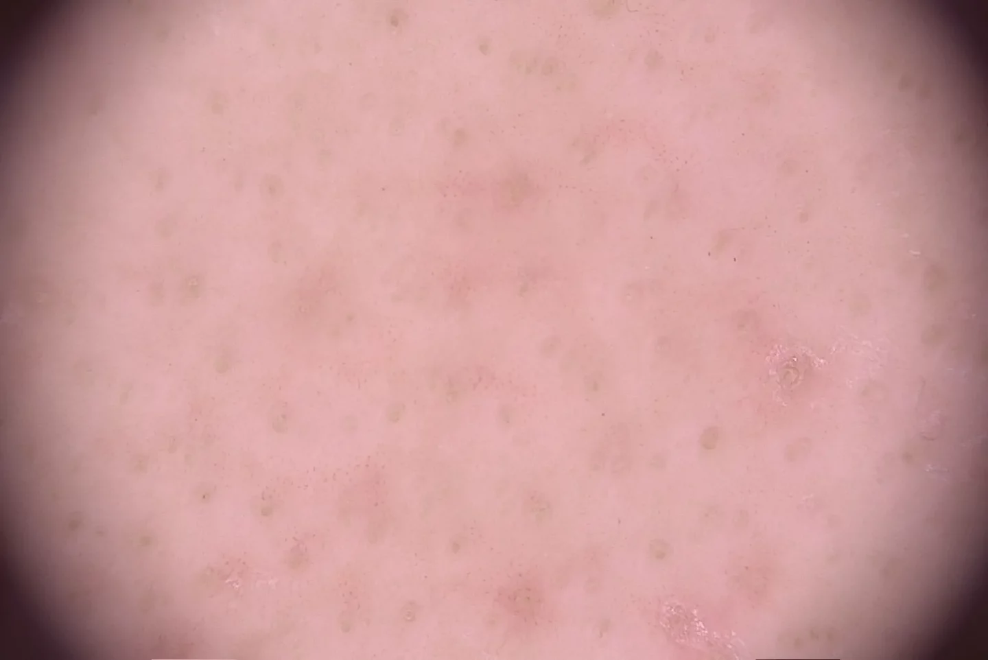 immagine tricoscopica di cute con alopecia areata cronica