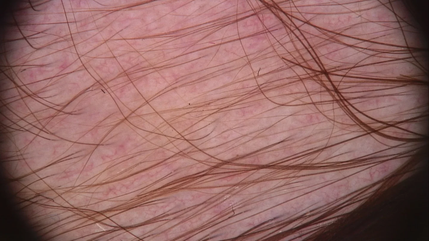 immagine tricoscopica di cute con alopecia areata in fase di ricrescita