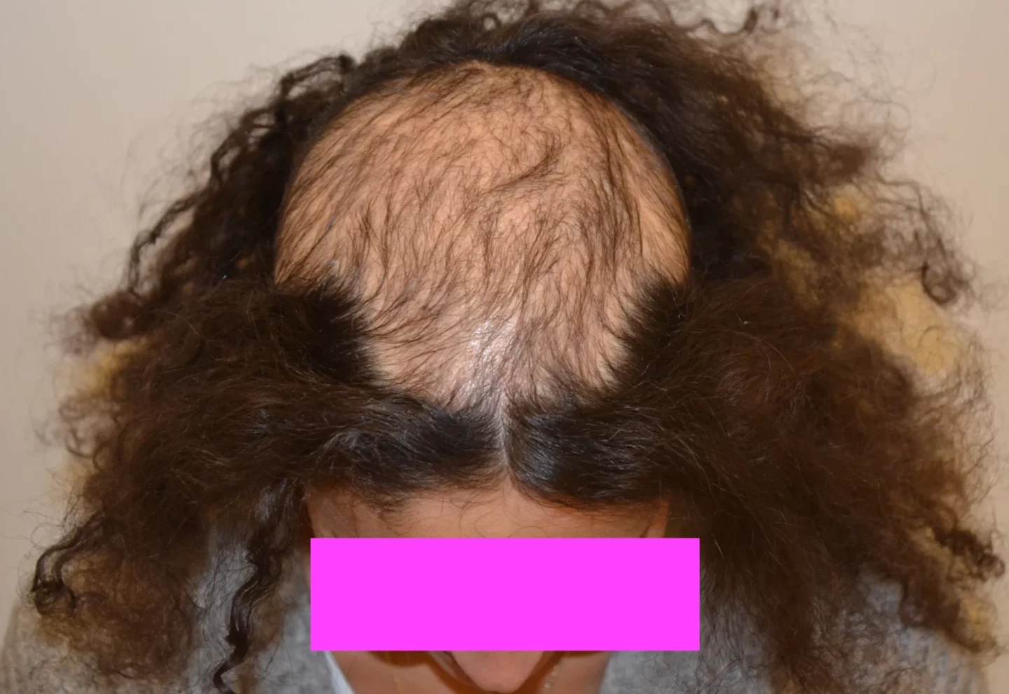 alopecia da tricotillomania