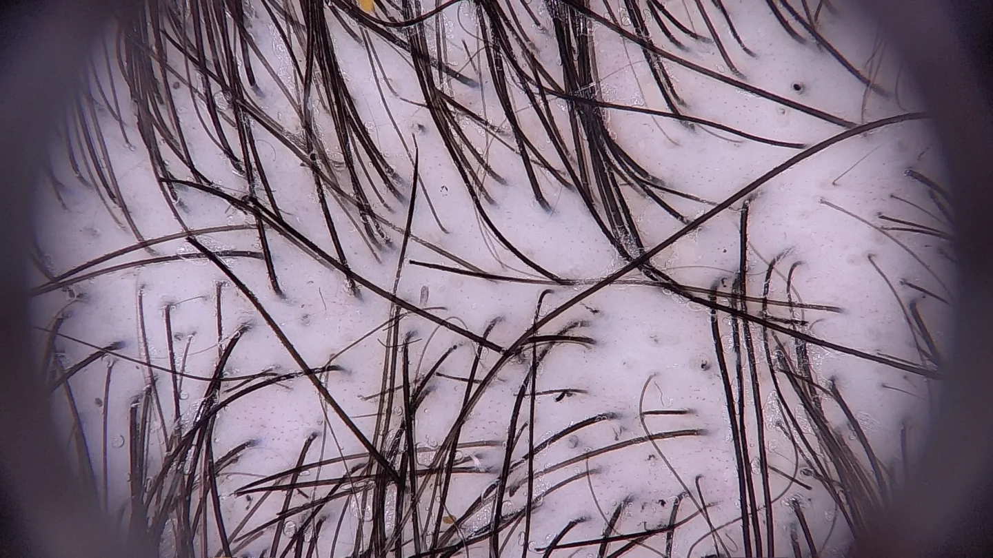 tricoscopia di paziente con tricotillomania