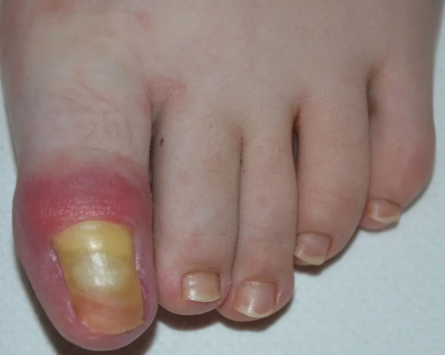 unghia gialla e piega ungueale infiammata