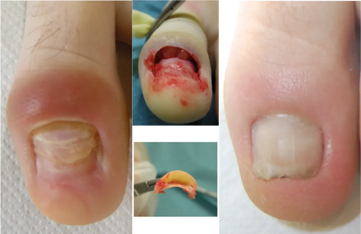 guarigione di retronichia di grado grave