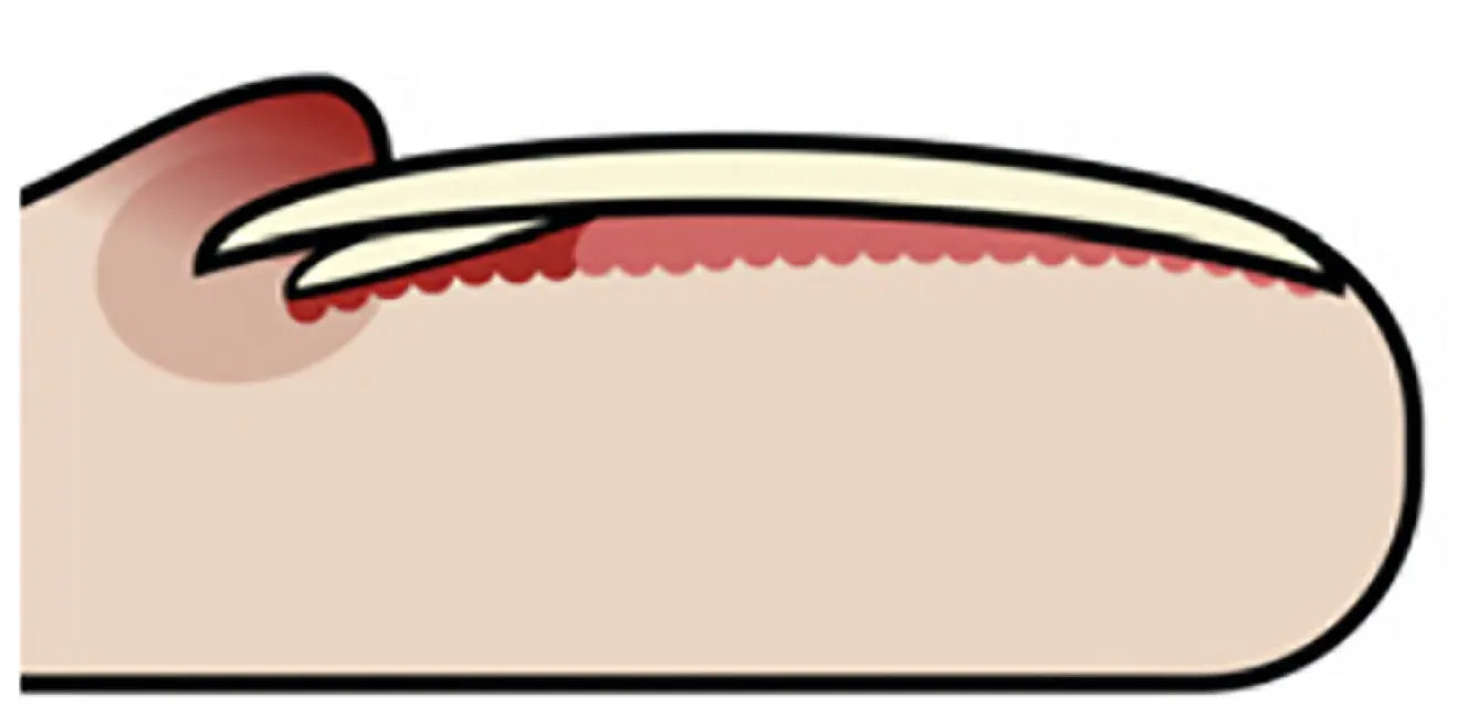 schema della retronichia