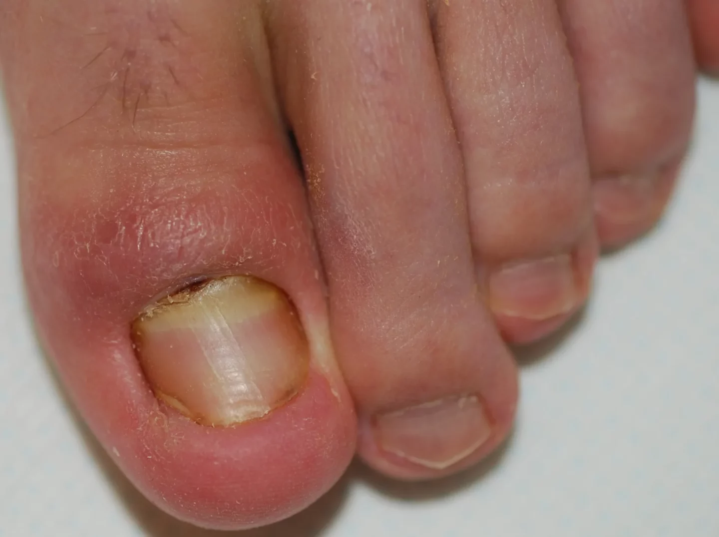 retronichia - fase inizale