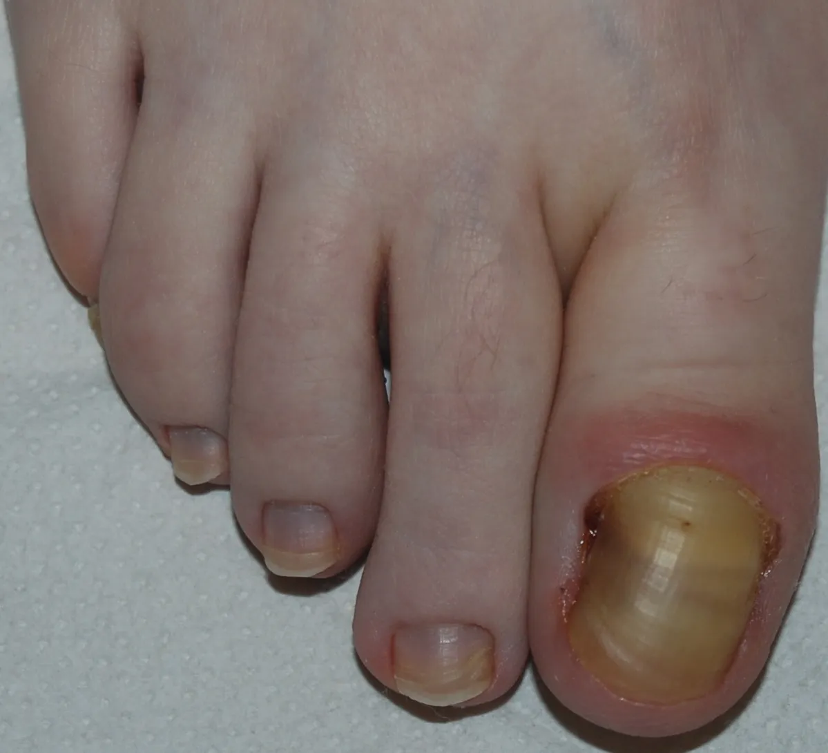 retronichia - fase avanzata