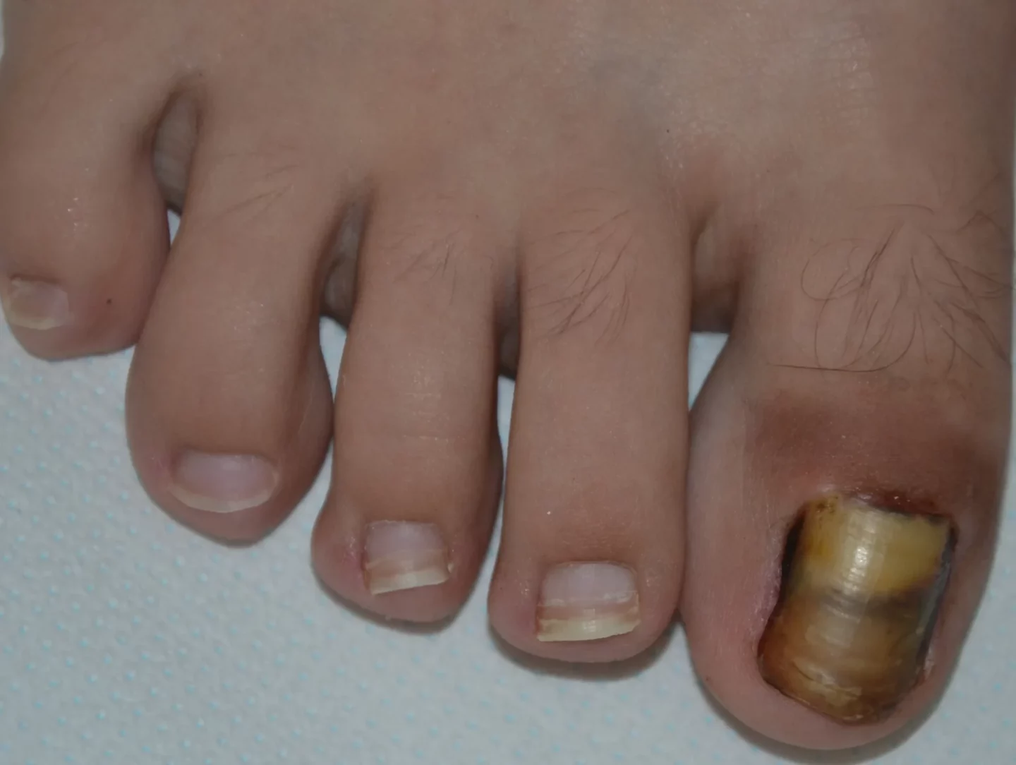 retronichia - fase avanzata con lamina staccata