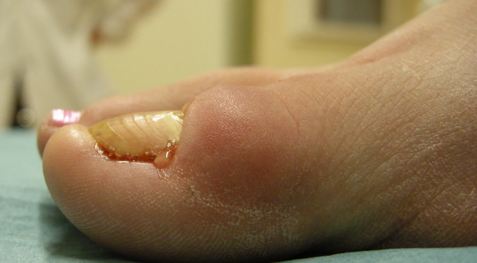 Quando le unghie degli alluci non crescono e la cute si infiamma: la retronichia