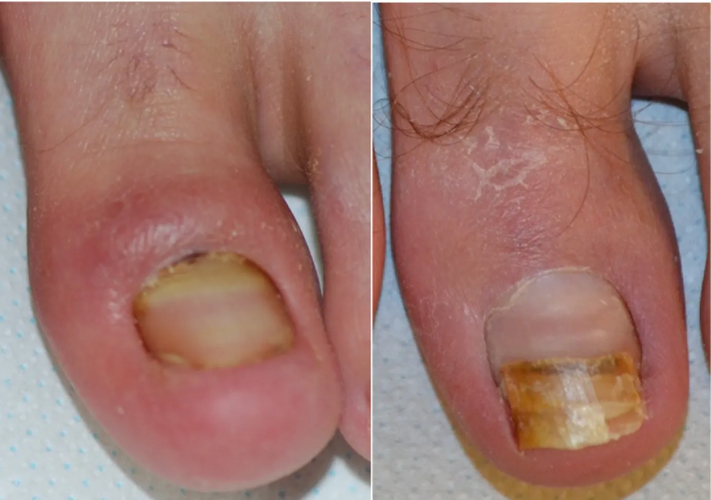 retronichia - guarigione