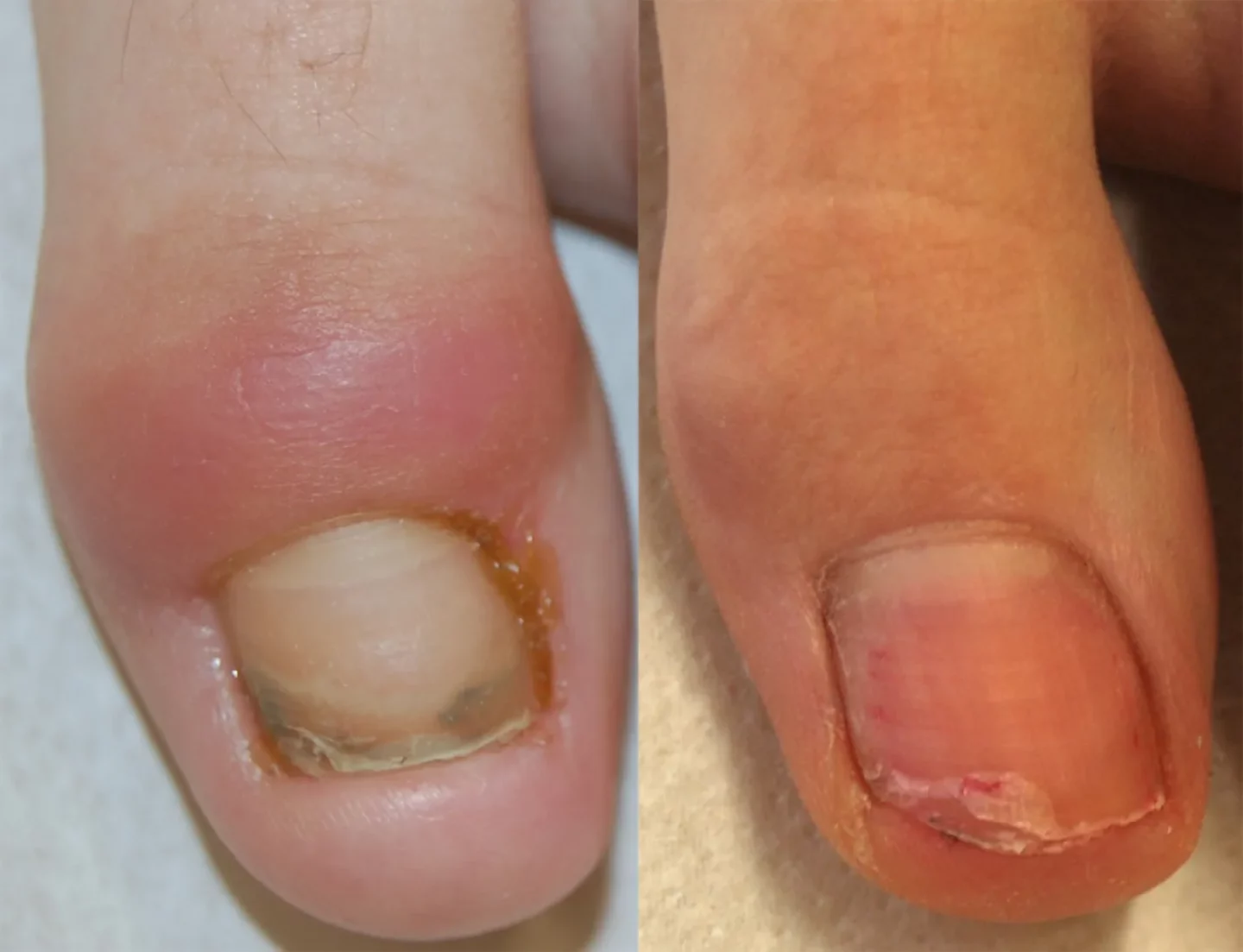 guarigione di retronichia di grado intermedio