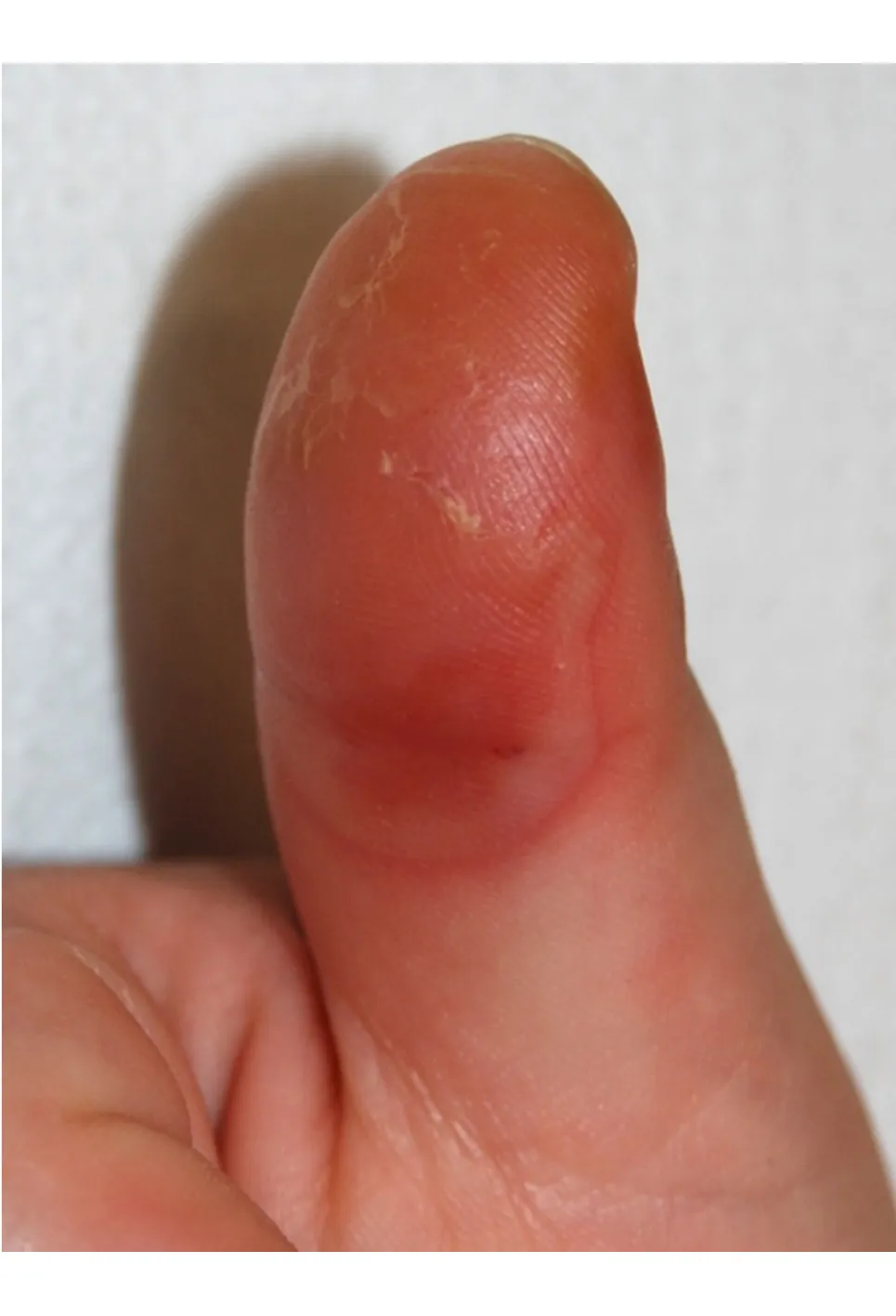 Fig. 1 L’abitudine dei neonati di succhiare il pollice può a volte provocare la comparsa di una bolla del polpastrello.