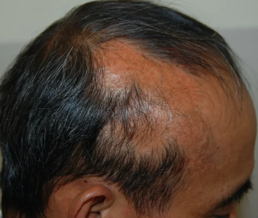 Alopecie cicatriziali: quando i capelli non possono più ricrescere