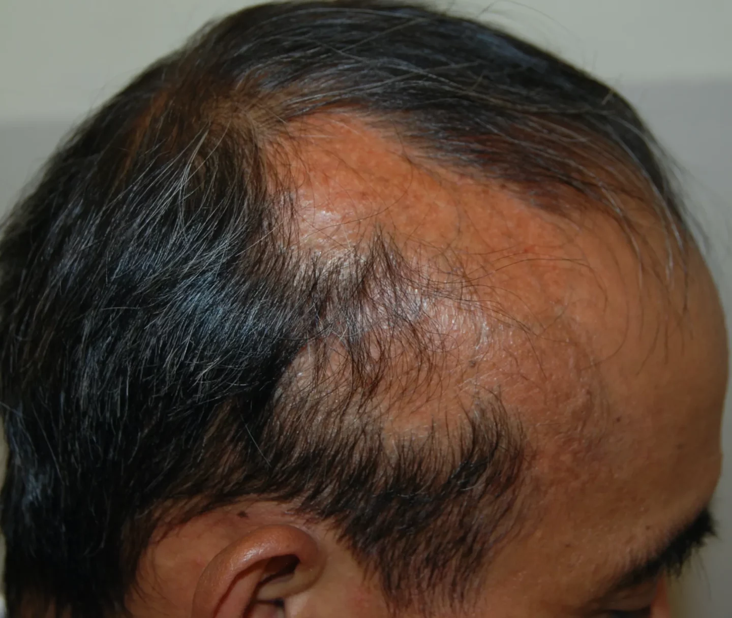 Fig. 1 Alopecia cicatriziale conseguente a una ustione del cuoio capelluto