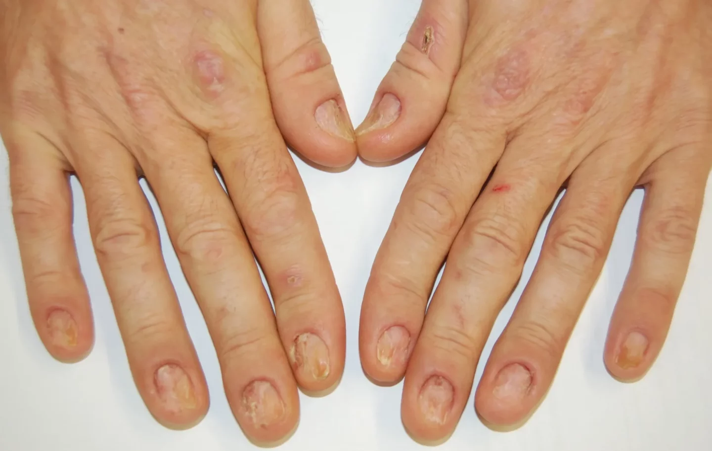 Fig. 9 Onicotillomania delle mani: la lamina di molte unghie è assente o interrotta; il letto mostra croste ematiche