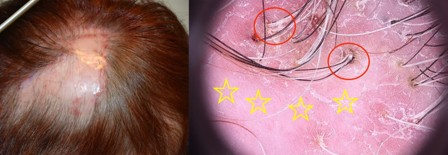 Fig. 10 Follicoliti decalvanti: chiazza di alopecia cicatriziale. La tricoscopia mostra la cicatrice, con assenza di osti follicolari (stelle gialle) e in periferia ciuffi di capelli che escono insieme dallo stesso ostio follicolare (anelli rossi).
