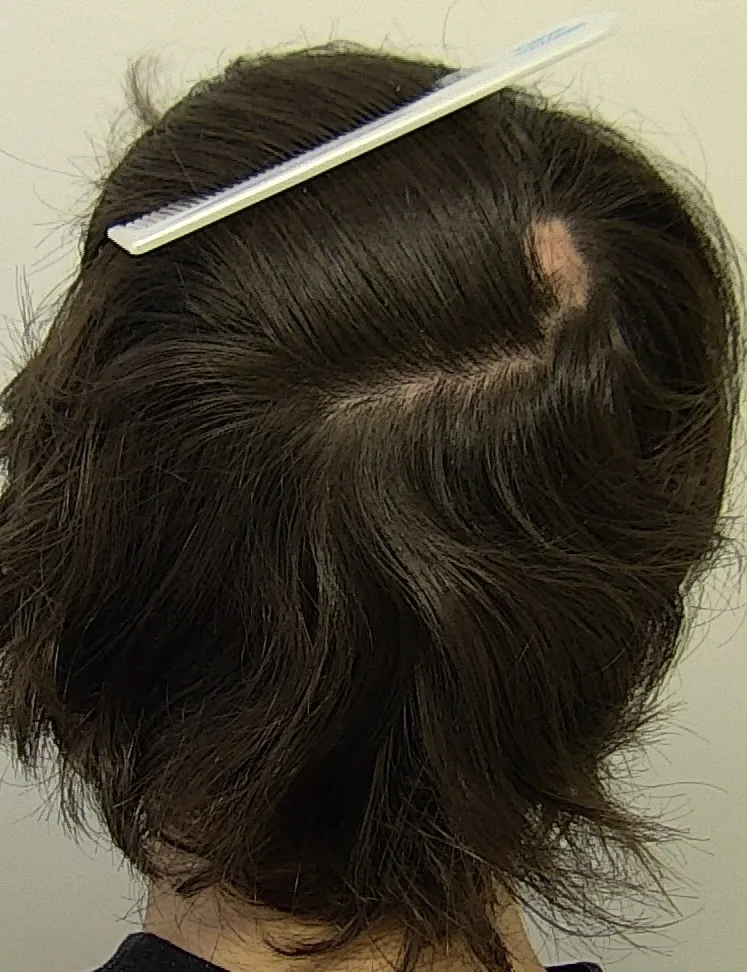 Fig. 12 Cellulite disseccante del cuoio capelluto: nelle forme iniziali può comparire una singola chiazza cicatriziale che sovrasta un nodulo palpabile e doloroso.