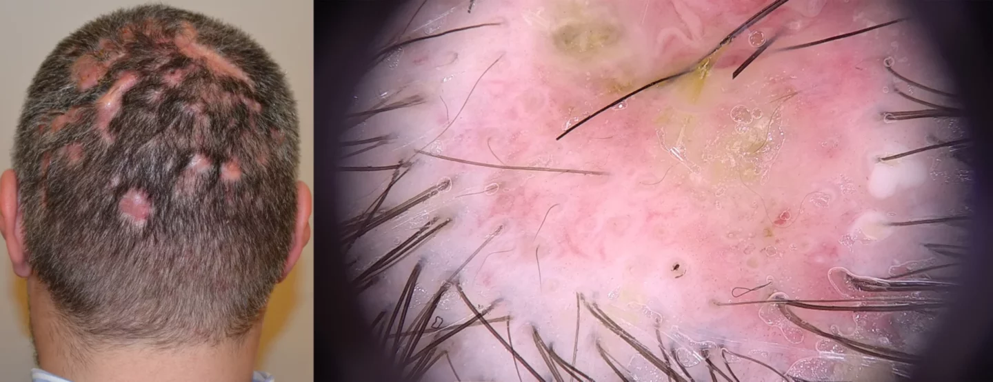 Fig. 13 Cellulite disseccante del cuoio capelluto: noduli e ascessi diffusi al capo.