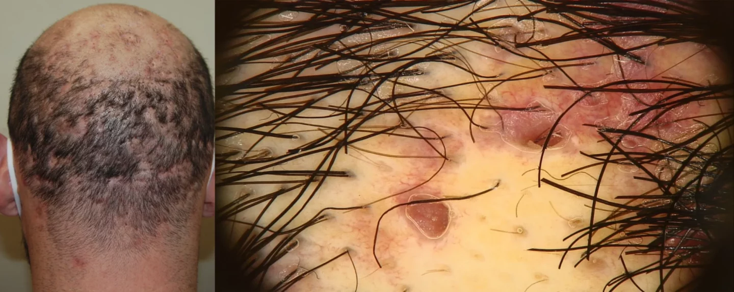 Fig. 14 Cellulite disseccante del cuoio capelluto in fase avanzata, con aree di alopecia cacatriziale diffuse.