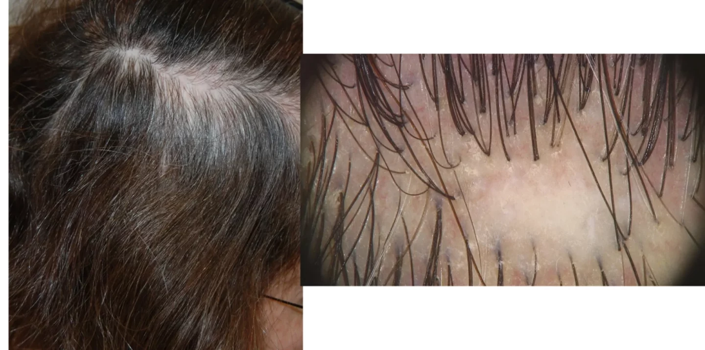 Fig. 2 L’aspetto tipico delle alopecie cicatriziali è l’assenza di osti follicolari visibili alla osservazione clinica e dermoscopica, a indicare la distruzione dei follicoli piliferi e la impossibilità di una ricrescita dei capelli.