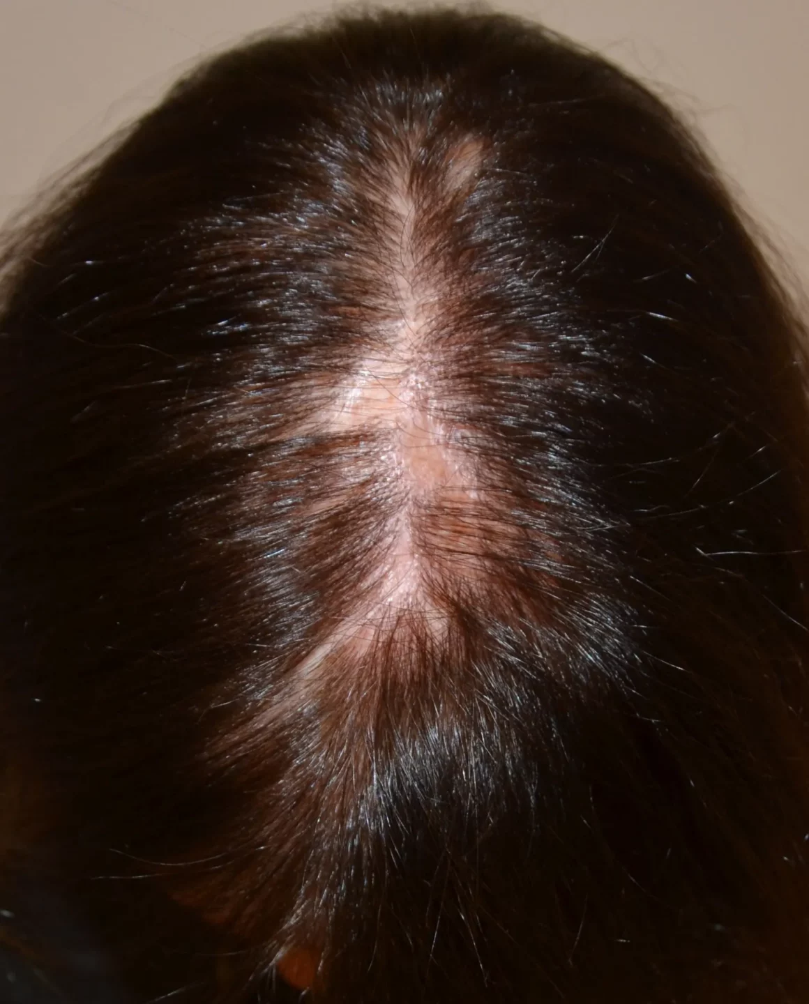 Fig. 3 Lichen plano-pilare del capo: piccole chiazze di alopecia cicatriziale, fuse fra loro, alla sommità del capo.