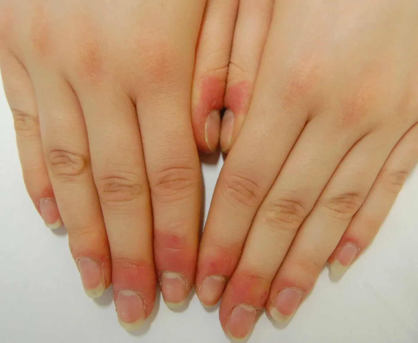 Fig. 4 Onicofagia dei tessuti periungueali: il paziente strappa con i denti pezzetti di cute periungueale, creando piccole abrasioni e infiammazione.