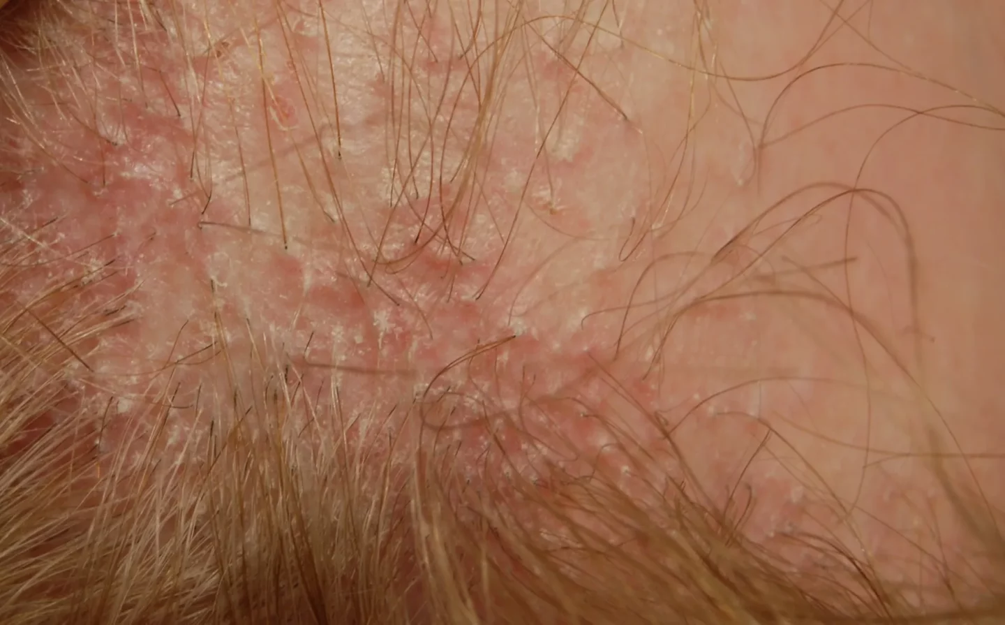 Fig. 4 Lichen plano-pilare del capo: anche a occhio nudo si possono osservare aree eritematose con squame attorno all’emergenza dei capelli.